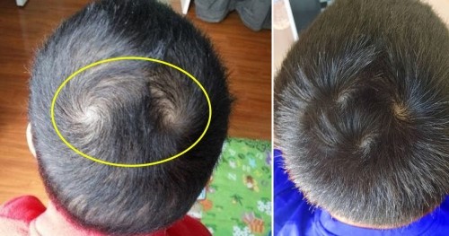 Tại sao số  xoáy tóc trên đầu trẻ lại khác nhau? Có phải do sức khỏe hay có lý do nào khác đằng sau?